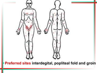 ▶Preferred sites interdegital, popliteal fold and groin
 