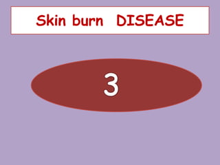 Skin burn DISEASE
 
