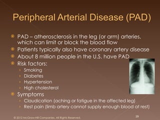    PAD – atherosclerosis in the leg (or arm) arteries,
    which can limit or block the blood flow
   Patients typically also have coronary artery disease
   About 8 million people in the U.S. have PAD
   Risk factors:
    ›   Smoking
    ›   Diabetes
    ›   Hypertension
    ›   High cholesterol
   Symptoms
    › Claudication (aching or fatigue in the affected leg)
    › Rest pain (limb artery cannot supply enough blood at rest)

© 2012 McGraw-Hill Companies. All Rights Reserved.       29
 