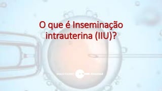 O que é Inseminação
intrauterina (IIU)?
 