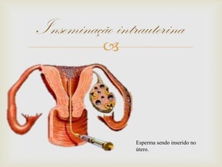 
Inseminação intrauterina
Esperma sendo inserido no
útero.
 