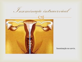 
Inseminação intracervical
Inseminação no cervix.
 