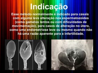 Indicação
Esse método normalmente é indicado para casais
com alguma leve alteração nos espermatozoides
(como gametas lentos ou com dificuldades de
movimentação), para casos de alteração no útero,
como uma endometriose leve ou mesmo quando não
há uma razão aparente para a infertilidade.
 