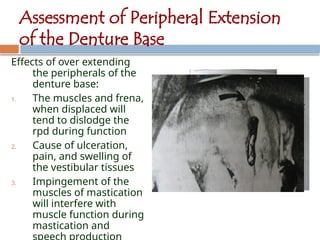 insertion-and-postinsertion-of-rpd-240427004558-82e51de2.pptx