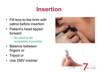 Insertion
• Fill lens to the brim with
saline before insertion
• Patient’s head tipped
forward
– No need to be
completely horizontal
• Balance between
fingers or
• Tripod or
• Use DMV inserter
 