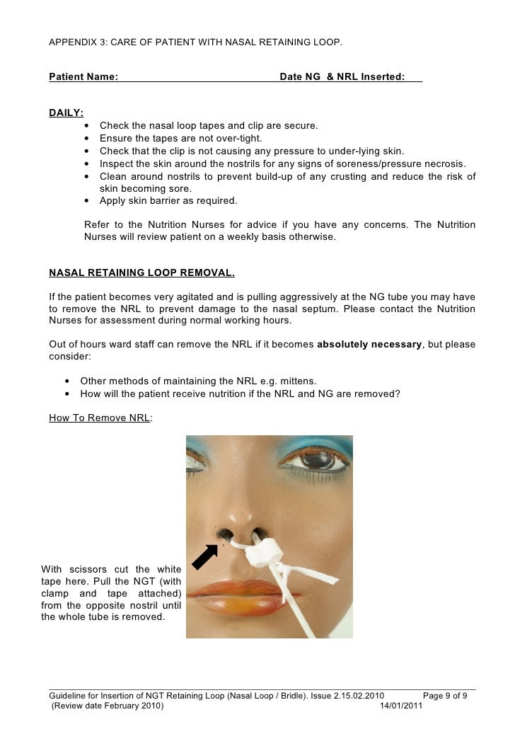 Insertion of ngt retaining device nasal loop bridle