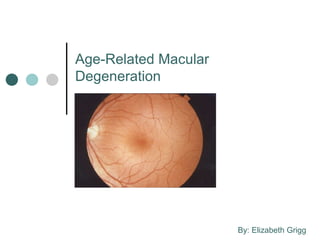 Age-Related Macular Degeneration By: Elizabeth Grigg 