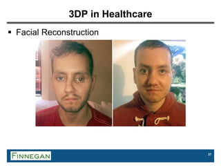 37
3DP in Healthcare
 Facial Reconstruction
 