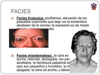 FACIES
c)   Facies tirotoxica: exoftalmos, elevación de los
     parpados superiores que deja ver la esclerótica
     alrededor de la cornea; la expresión es de miedo
     intenso, sorpresa o susto.




d)   Facies mixedematosa: la cara es
     ancha, redonda, abotagada, los parpados
     abultados, la hendidura palpebral es estrecha, los
     ojos son pequeños y hundidos, la mirada esta
     apagada, la nariz es ancha, y labios gruesos.
 