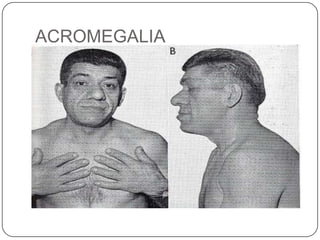 ACROMEGALIA
 