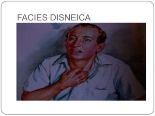 FACIES DISNEICA
 