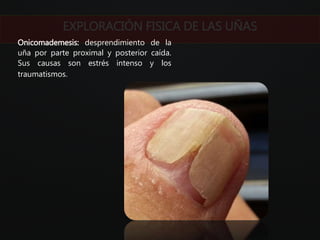 EXPLORACIÓN FISICA DE LAS UÑAS
Onicomademesis: desprendimiento de la
uña por parte proximal y posterior caída.
Sus causas son estrés intenso y los
traumatismos.
 