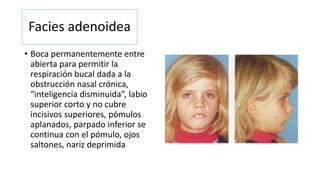 Facies adenoidea 
• Boca permanentemente entre 
abierta para permitir la 
respiración bucal dada a la 
obstrucción nasal crónica, 
“inteligencia disminuida”, labio 
superior corto y no cubre 
incisivos superiores, pómulos 
aplanados, parpado inferior se 
continua con el pómulo, ojos 
saltones, nariz deprimida 
 