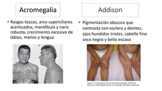 Acromegalia 
• Rasgos toscos, arco superciliares 
acentuados, mandíbula y nariz 
robusta, crecimiento excesivo de 
labios, manos y lengua 
Addison 
• Pigmentación obscura que 
contrasta con esclera y dientes, 
ojos hundidos tristes, cabello fino 
seco negro y bello escaso 
 