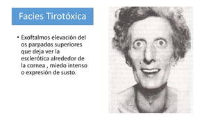 Facies Tirotóxica 
• Exoftalmos elevación del 
os parpados superiores 
que deja ver la 
esclerótica alrededor de 
la cornea , miedo intenso 
o expresión de susto. 
 