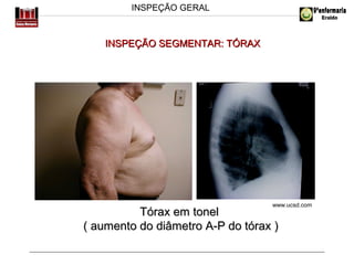 INSPEÇÃO GERAL

INSPEÇÃO SEGMENTAR: TÓRAX

www.ucsd.com

Tórax em tonel
( aumento do diâmetro A-P do tórax )

 