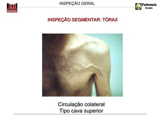INSPEÇÃO GERAL

INSPEÇÃO SEGMENTAR: TÓRAX

Circulação colateral
Tipo cava superior

 
