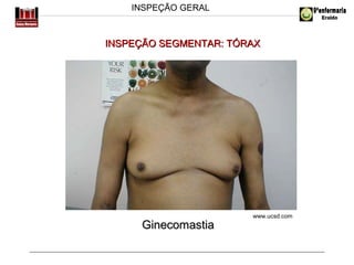 INSPEÇÃO GERAL

INSPEÇÃO SEGMENTAR: TÓRAX

Ginecomastia

www.ucsd.com

 