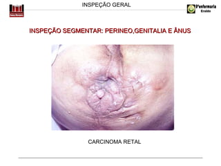INSPEÇÃO GERAL

INSPEÇÃO SEGMENTAR: PERINEO,GENITALIA E ÂNUS

CARCINOMA RETAL

 