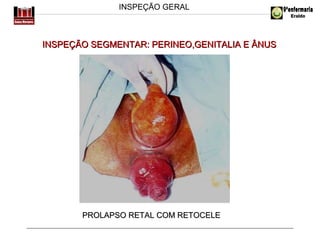 INSPEÇÃO GERAL

INSPEÇÃO SEGMENTAR: PERINEO,GENITALIA E ÂNUS

PROLAPSO RETAL COM RETOCELE

 