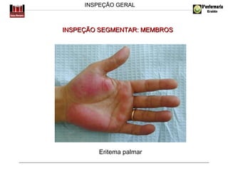 INSPEÇÃO GERAL

INSPEÇÃO SEGMENTAR: MEMBROS

Eritema palmar

 