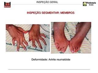 INSPEÇÃO GERAL

INSPEÇÃO SEGMENTAR: MEMBROS

Deformidade: Artrite reumatóide

 
