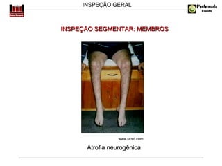 INSPEÇÃO GERAL

INSPEÇÃO SEGMENTAR: MEMBROS

www.ucsd.com

Atrofia neurogênica

 