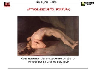 INSPEÇÃO GERAL

ATITUDE (DECÚBITO / POSTURA)

Contratura muscular em paciente com tétano.
Pintado por Sir Charles Bell, 1809

 
