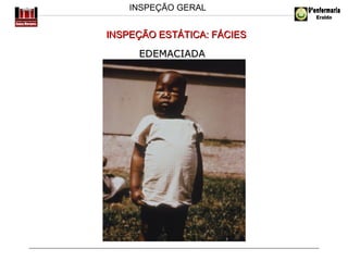 INSPEÇÃO GERAL

INSPEÇÃO ESTÁTICA: FÁCIES
EDEMACIADA

 