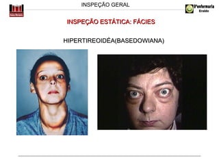 INSPEÇÃO GERAL

INSPEÇÃO ESTÁTICA: FÁCIES
HIPERTIREOIDÉA(BASEDOWIANA)

 