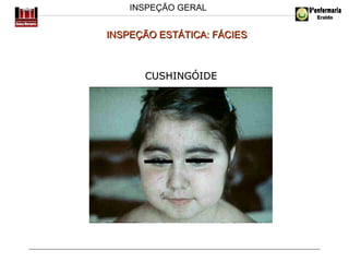 INSPEÇÃO GERAL

INSPEÇÃO ESTÁTICA: FÁCIES

CUSHINGÓIDE

 