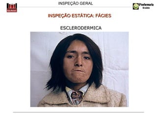 INSPEÇÃO GERAL

INSPEÇÃO ESTÁTICA: FÁCIES
ESCLERODERMICA

 