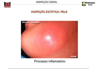 INSPEÇÃO GERAL

INSPEÇÃO ESTÁTICA: PELE

Processo inflamatório

 