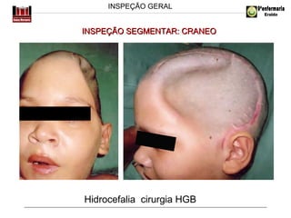 INSPEÇÃO GERAL

INSPEÇÃO SEGMENTAR: CRANEO

Hidrocefalia cirurgia HGB

 