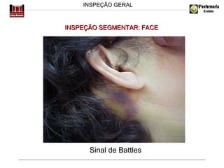 INSPEÇÃO GERAL

INSPEÇÃO SEGMENTAR: FACE

Sinal de Battles

 