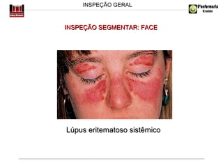 INSPEÇÃO GERAL

INSPEÇÃO SEGMENTAR: FACE

Lúpus eritematoso sistêmico

 