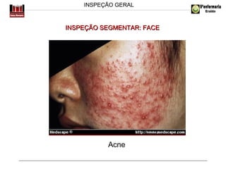 INSPEÇÃO GERAL

INSPEÇÃO SEGMENTAR: FACE

Acne

 