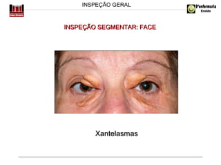 INSPEÇÃO GERAL

INSPEÇÃO SEGMENTAR: FACE

Xantelasmas

 