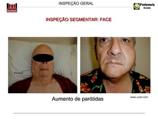INSPEÇÃO GERAL

INSPEÇÃO SEGMENTAR: FACE

Aumento de parótidas

www.ucsd.com

 