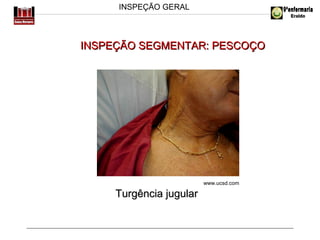 INSPEÇÃO GERAL

INSPEÇÃO SEGMENTAR: PESCOÇO

www.ucsd.com

Turgência jugular

 