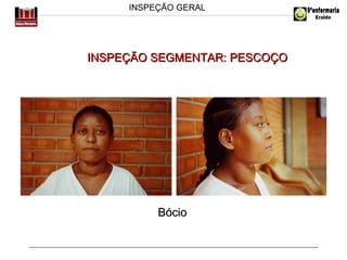 INSPEÇÃO GERAL

INSPEÇÃO SEGMENTAR: PESCOÇO

Bócio

 