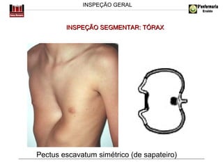 INSPEÇÃO GERAL

INSPEÇÃO SEGMENTAR: TÓRAX

Pectus escavatum simétrico (de sapateiro)

 