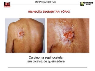 INSPEÇÃO GERAL

INSPEÇÃO SEGMENTAR: TÓRAX

Carcinoma espinocelular
em cicatriz de queimadura

 