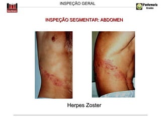 INSPEÇÃO GERAL

INSPEÇÃO SEGMENTAR: ABDOMEN

Herpes Zoster

 