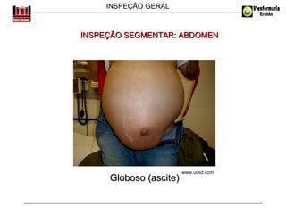 INSPEÇÃO GERAL

INSPEÇÃO SEGMENTAR: ABDOMEN

Globoso (ascite)

www.ucsd.com

 