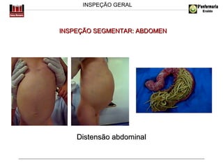 INSPEÇÃO GERAL

INSPEÇÃO SEGMENTAR: ABDOMEN

Distensão abdominal

 