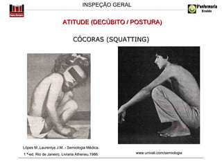 INSPEÇÃO GERAL

ATITUDE (DECÚBITO / POSTURA)
CÓCORAS (SQUATTING)

Lópes M.,Laurentys J.M. - Semiologia Médica.
1 ª-ed. Rio de Janeiro, Livraria Atheneu,1986.

www.univali.com/semiologia

 