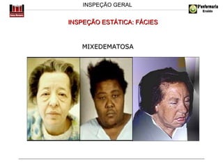 INSPEÇÃO GERAL

INSPEÇÃO ESTÁTICA: FÁCIES

MIXEDEMATOSA

 