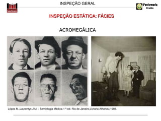 INSPEÇÃO GERAL

INSPEÇÃO ESTÁTICA: FÁCIES
ACROMEGÁLICA

Lópes M.,Laurentys J.M. - Semiologia Médica.1 ª-ed. Rio de Janeiro,Livraria Atheneu,1986.

 
