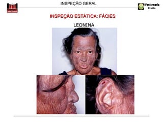 INSPEÇÃO GERAL

INSPEÇÃO ESTÁTICA: FÁCIES
LEONINA

 